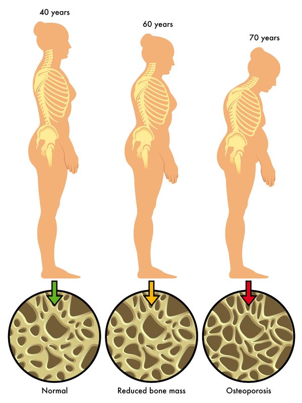 Osteoporosis in Women - Curved Spine with Age