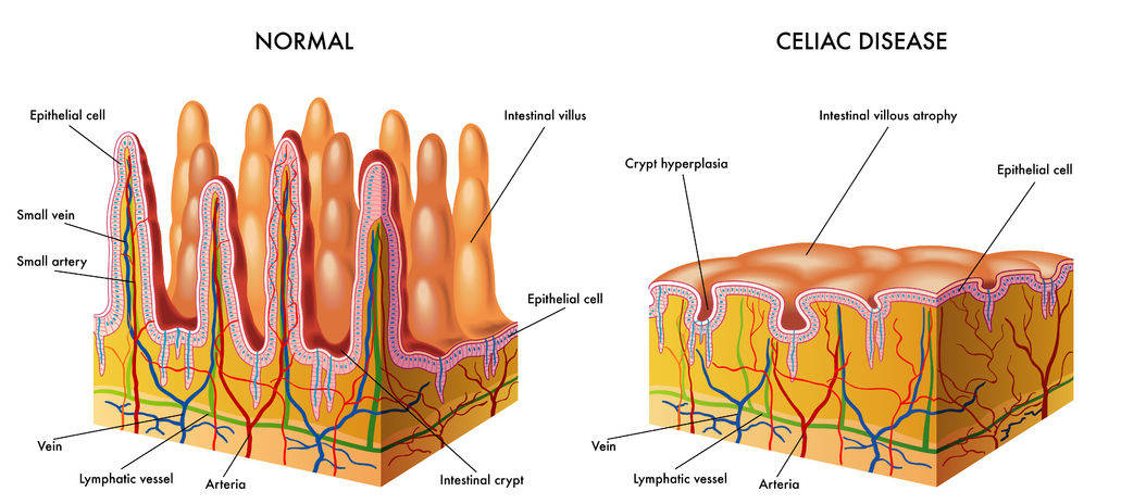 Normal small intestine vs. celiac disease