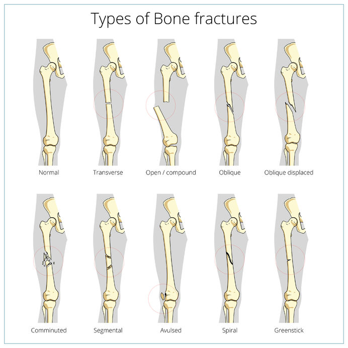 understanding-bone-fractures