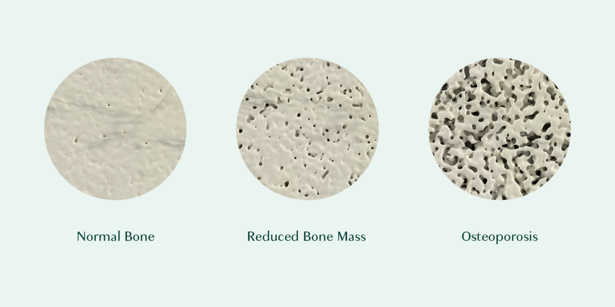 bones at different stages of low calcium levels