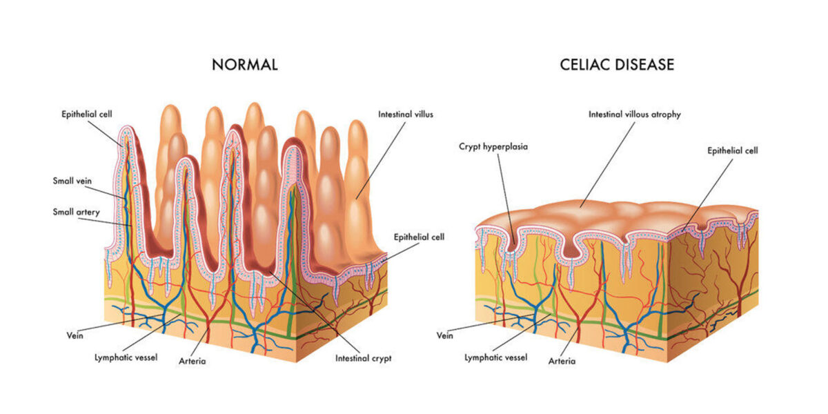 Celiac disease 