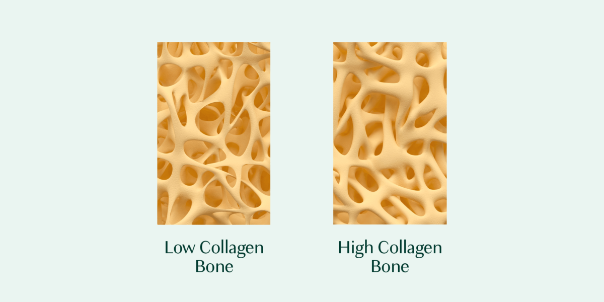 Low collagen bone versus high collagen bone