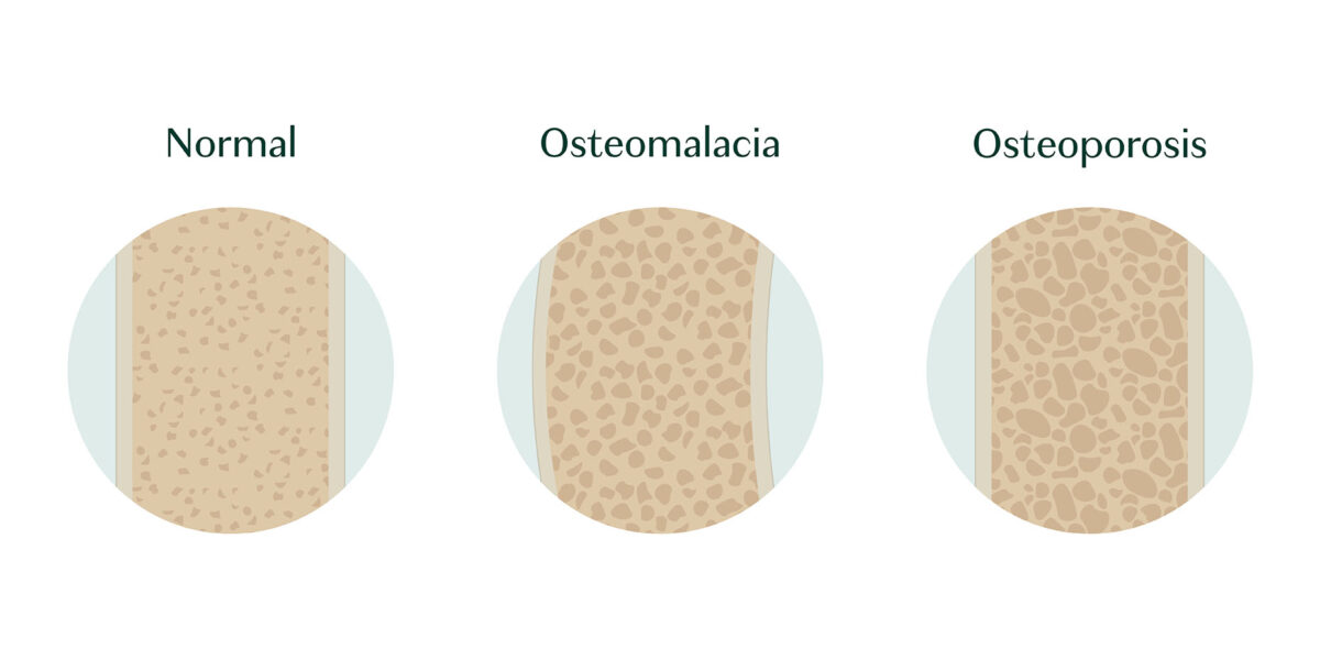 Difference between osteoporosis vs osteomalacia