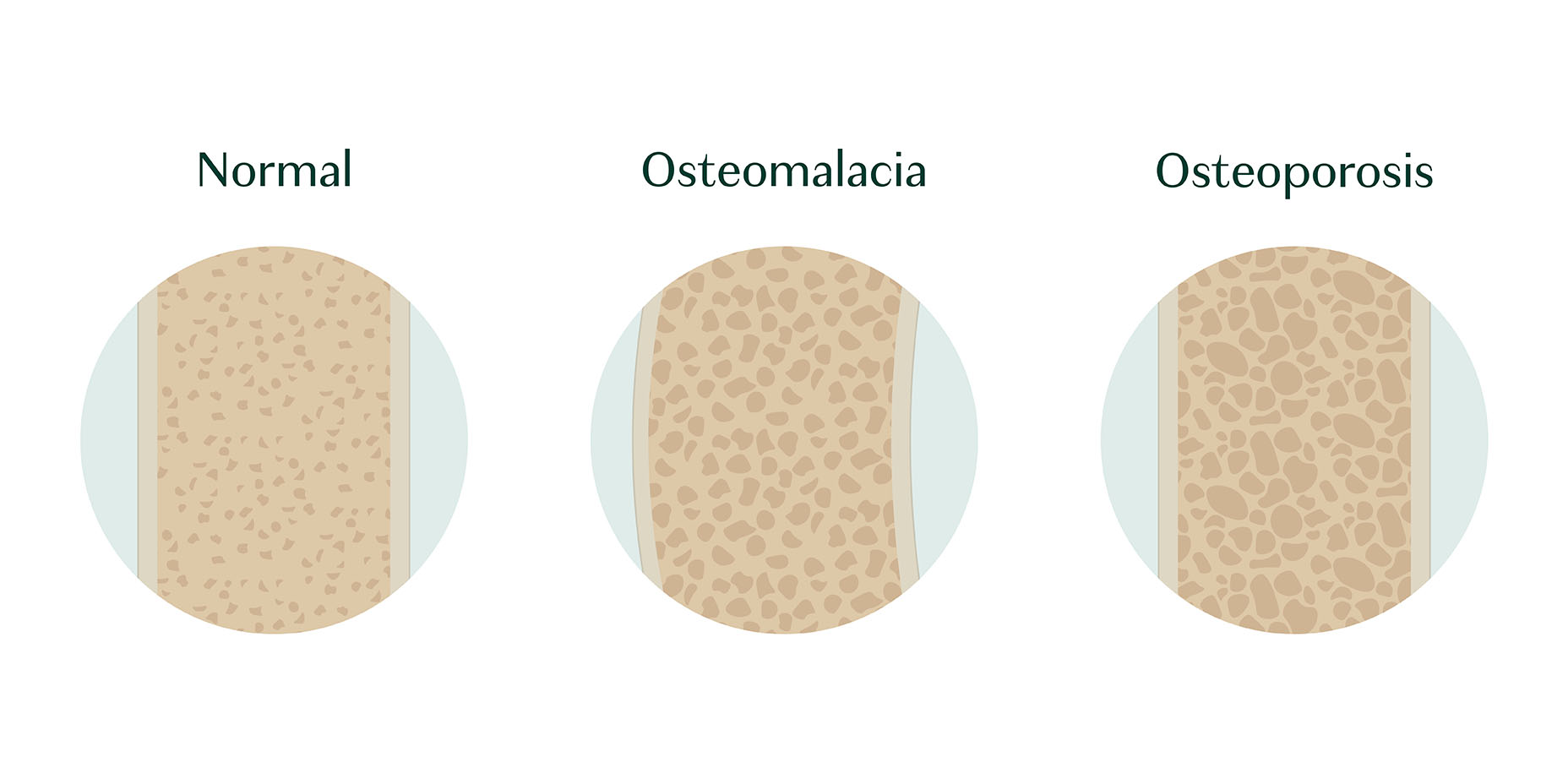 Osteomalacia vs. Osteoporosis AlgaeCal