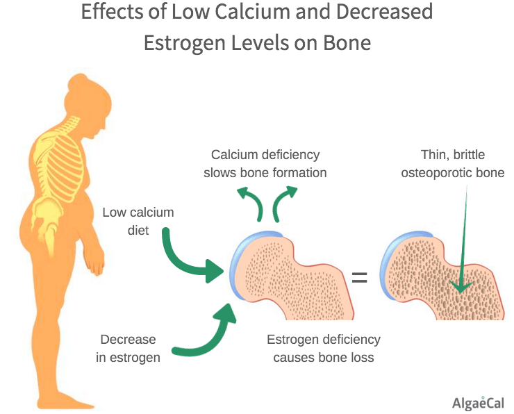 Postmenopausal Osteoporosis - Low Calcium and Estrogen