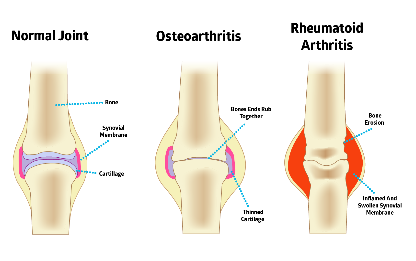 osteoarthritis vs rheumatoid arthritis comparison 